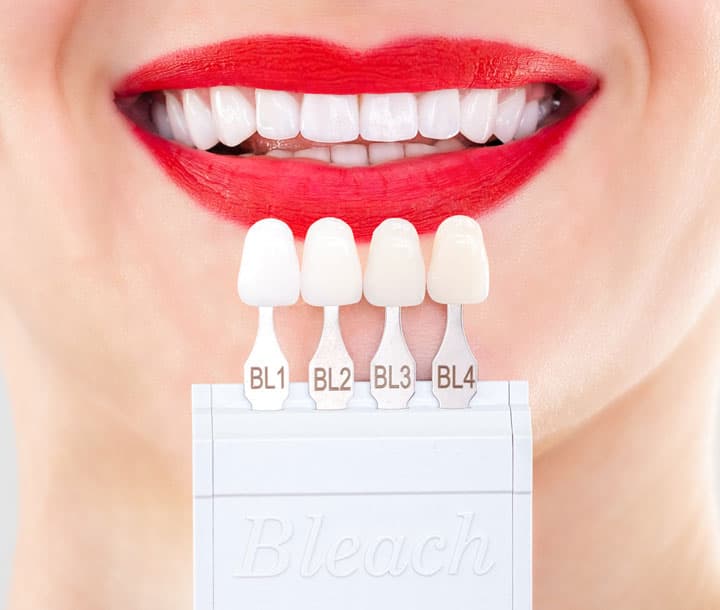 Hacer un blanqueamiento dental en Ferrol