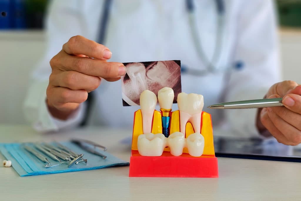 Beneficios de los implantes dentales en Ferrol