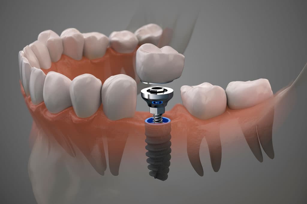 Poner un implante dental en Ferrol