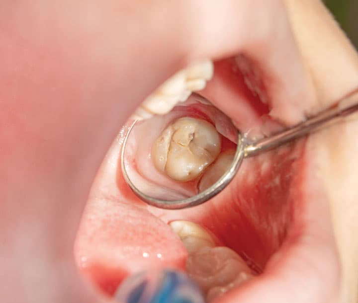 Hacer un empaste o endodoncia en clínica dental de Ferrol