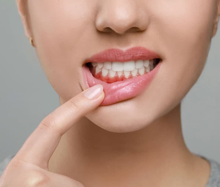 Tratar la gingivitis en clínica dental de Ferrol