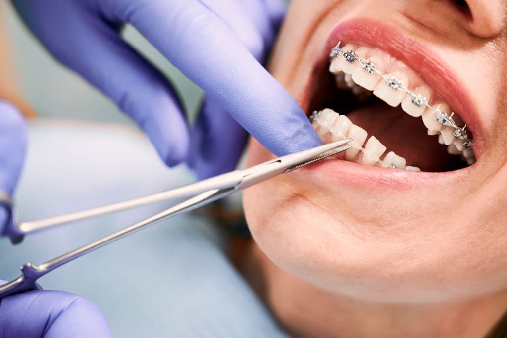 Poner aparatos dentales en Ferrol